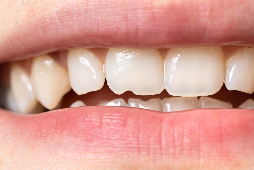 How Dental Crowns on Front Teeth Can Restore Smile